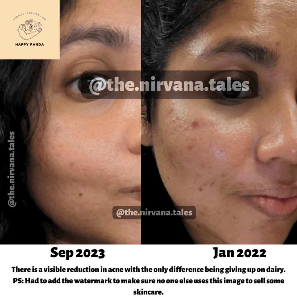 My acne flare ups have reduced since going vegan. These are photos that were taken 1.5 years apart and you can see the difference. This photo is owned by www.thenirvanatales.com. 